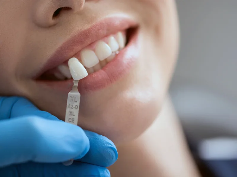 How Many Veneers Do I Need? Essential Shrewsbury PA Guide