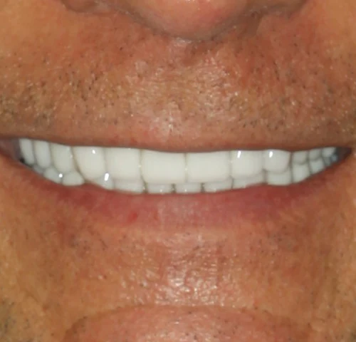 Case 1, after