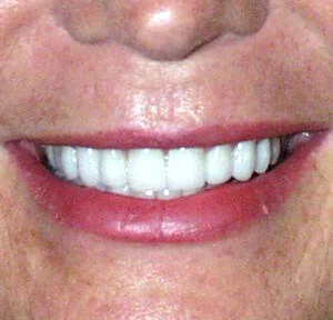 Case 4, after
