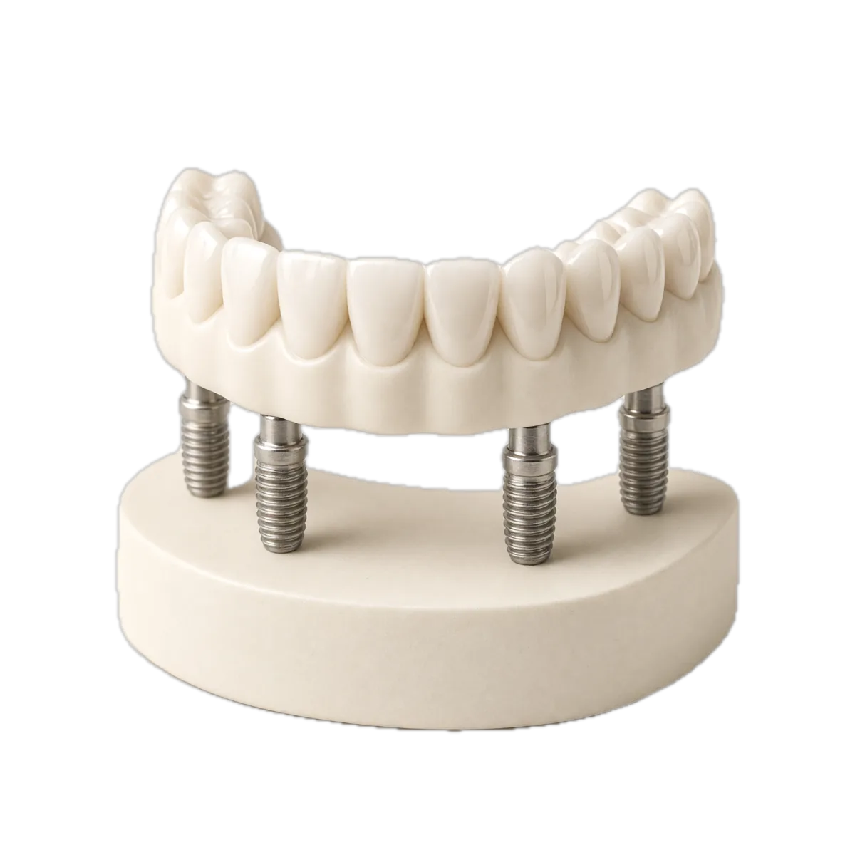 A full-arch dental implant model on four implants