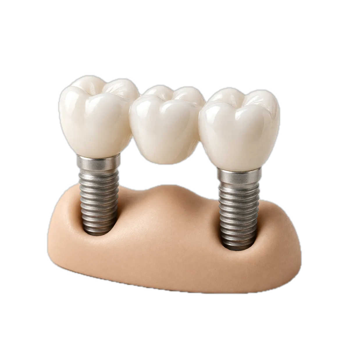 A porcelain bridge on two dental implants