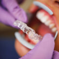 INVISALIGN CLEAR ALIGNERS – BEST ORTHODONTICS IN YORK PA