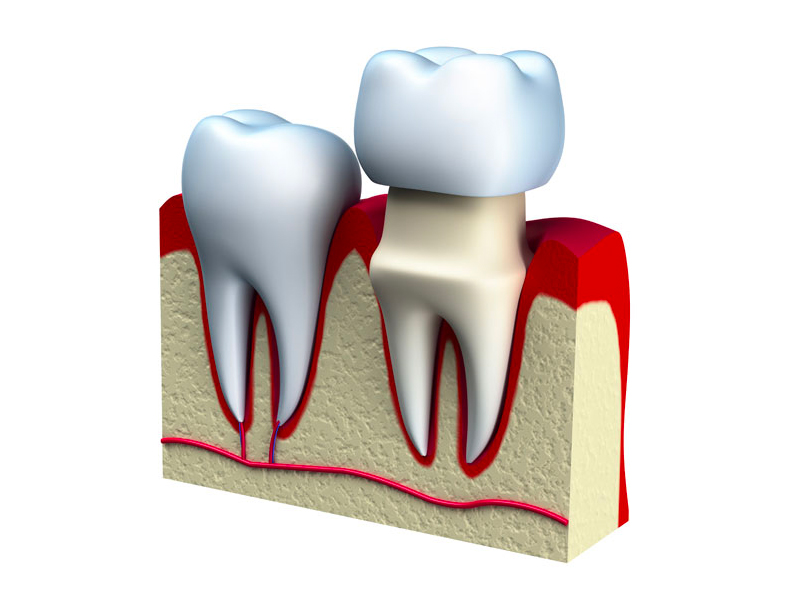 dental-inlay-onlay