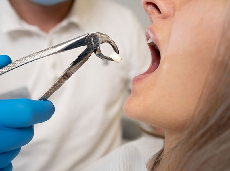 full-mouth-tooth-extraction