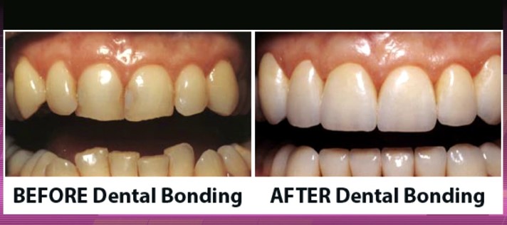 dental bonding new