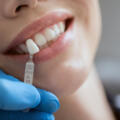 How Many Veneers Do I Need? Essential Shrewsbury PA Guide
