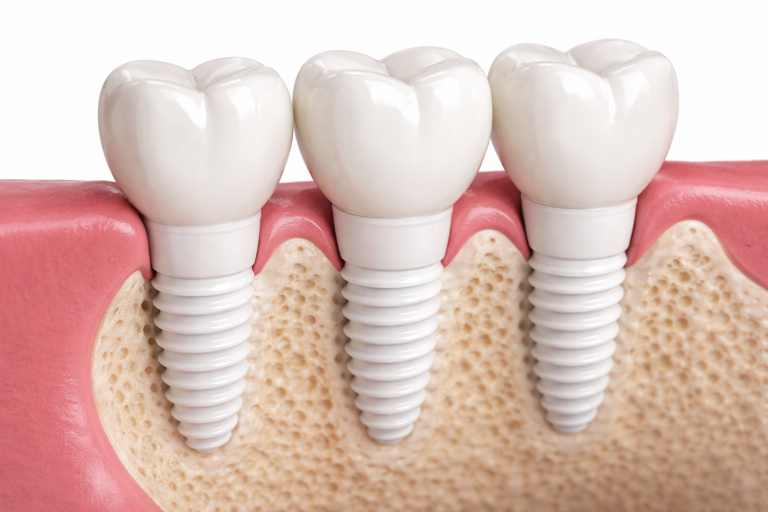 Ceramic Dental Implants vs Titanium Implants: Which Is Better ...