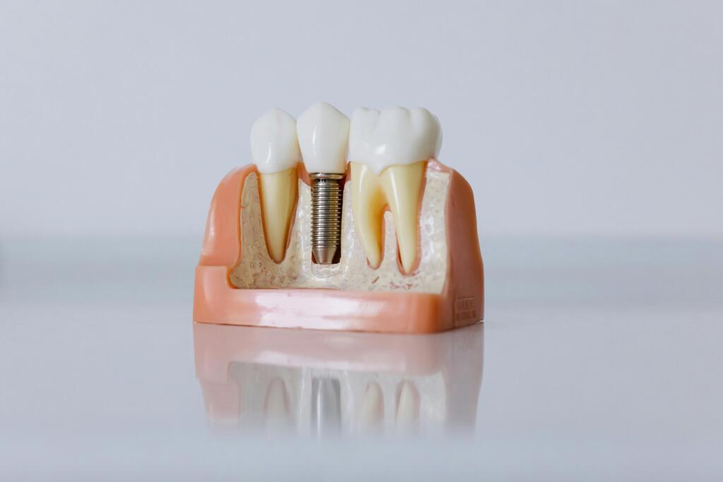 Dental Implant Cost in York PA