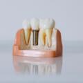 Dental Implant Cost in York PA: What Patients Should Know Before Treatment