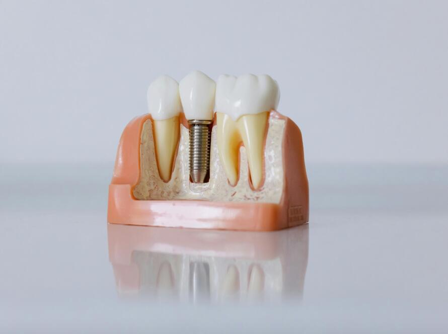 Dental Implant Cost in York PA